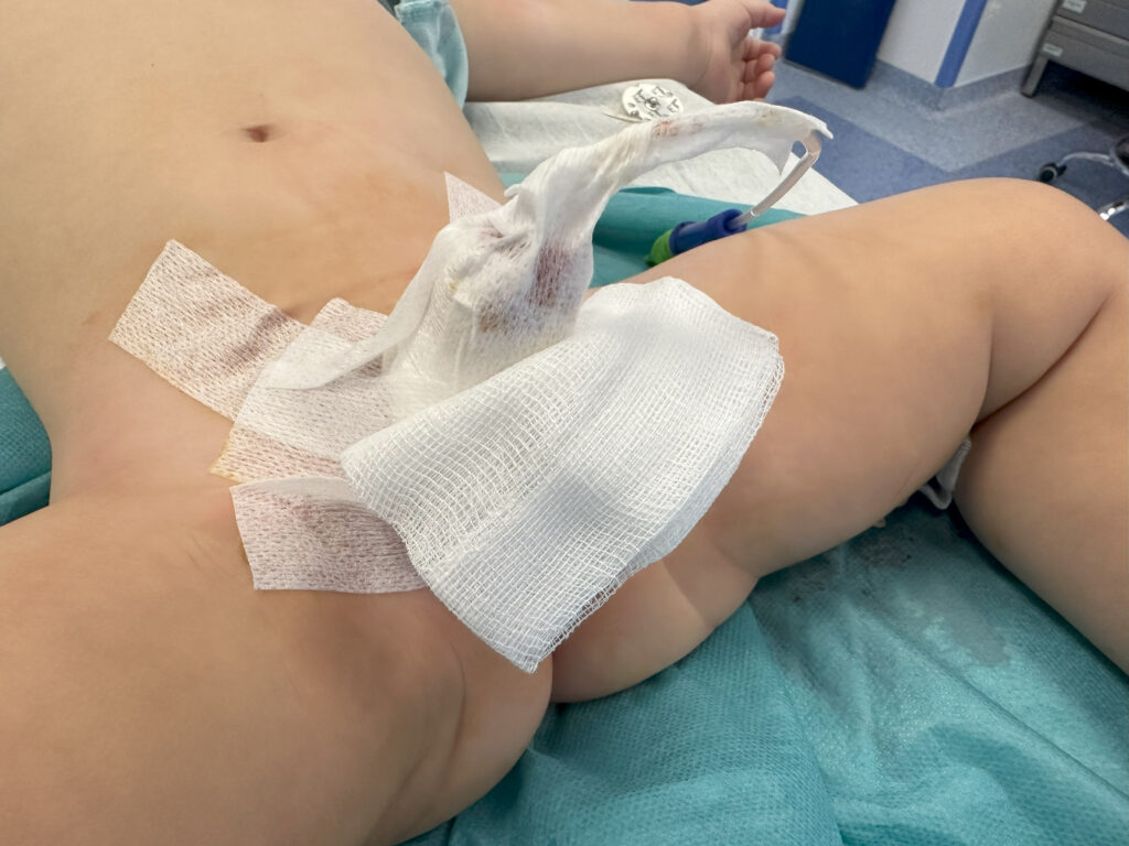 Opatrunek i pampersowanie chorego po zabiegu spodziectwa