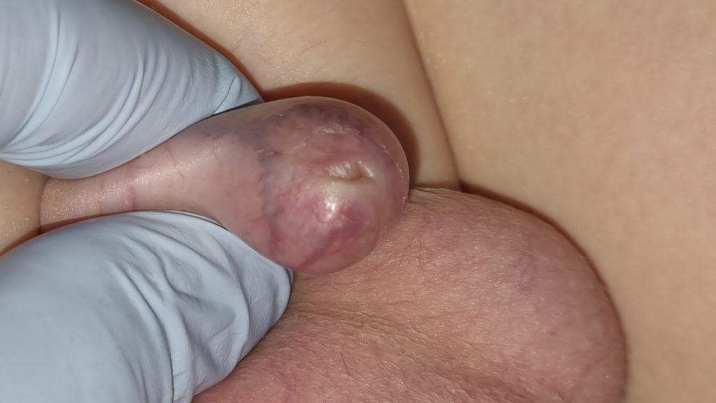 Bliznowata stulejka do leczenia chirurgicznego